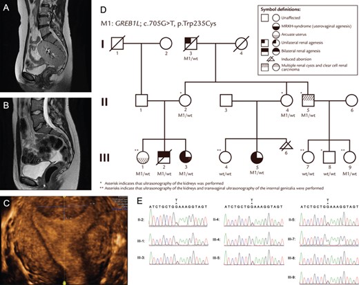Cover - Whole-exome sequencing identifies a GREB1L variant in a three-generation family with Müllerian and renal agenesis: a novel candidate gene in Mayer–Rokitansky–Küster–Hauser (MRKH) syndrome. A case report